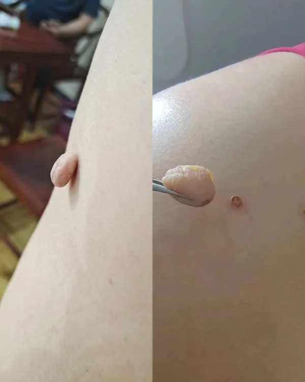 Skin tag removal — before and after showing a pedunculated skin tag removed with forceps