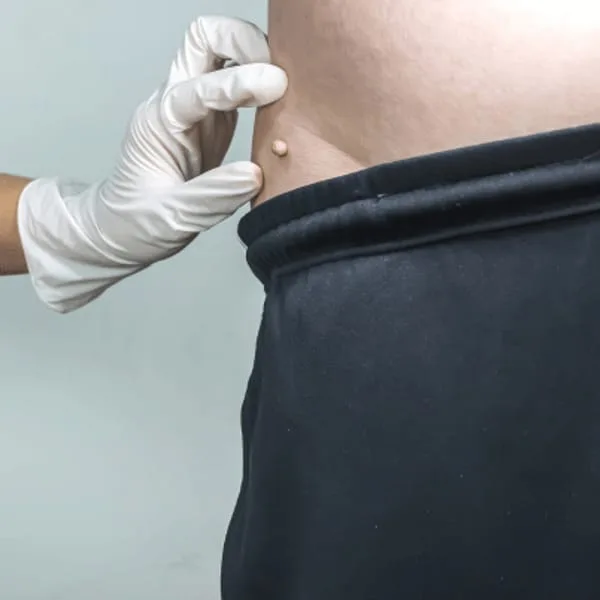 Skin tag assessment — white-gloved hands isolating a small skin tag