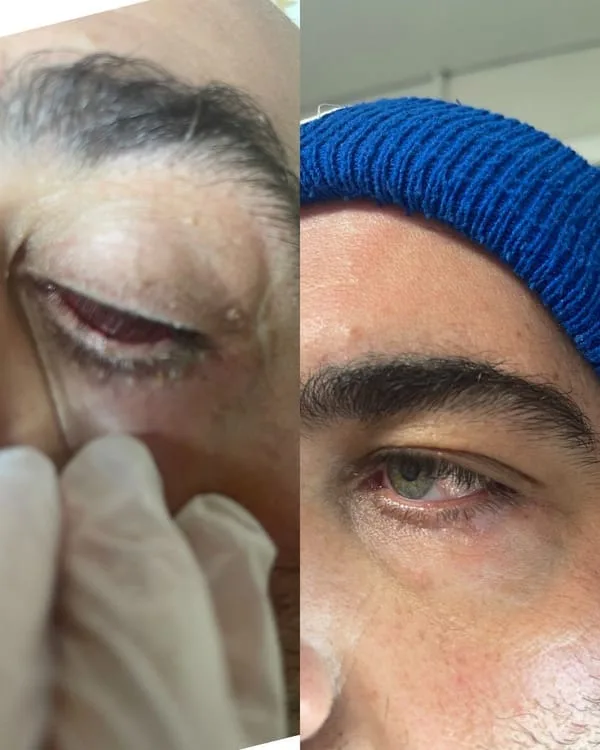 Skin lesion treatment — before and after result on upper eyelid area