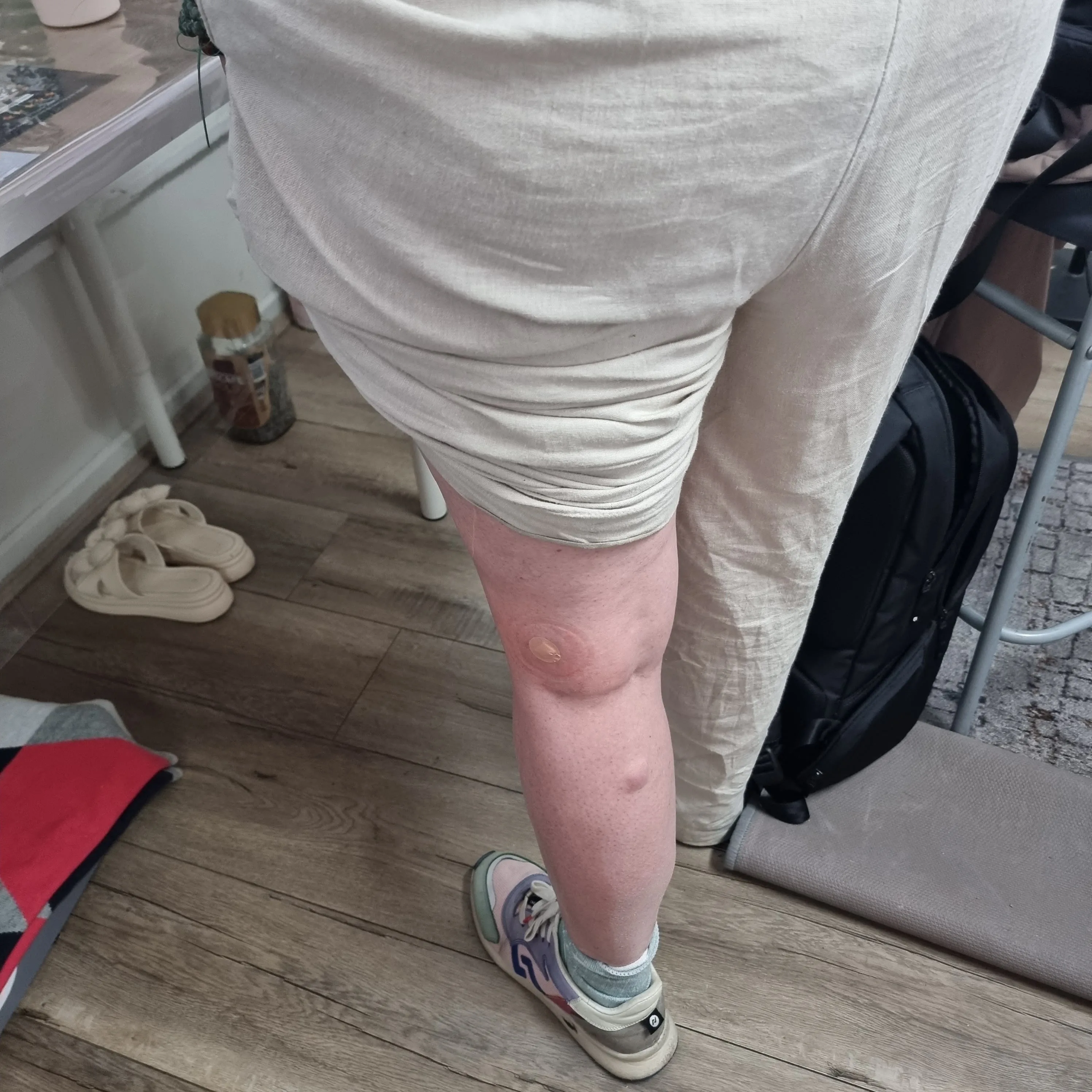 Skin care consultation — a lower leg with soft-tissue condition, pre-treatment